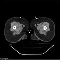 Carcinoma cervix- brachytherapy applicator (Radiopaedia 33135-34173 Axial non-contrast 75).jpg