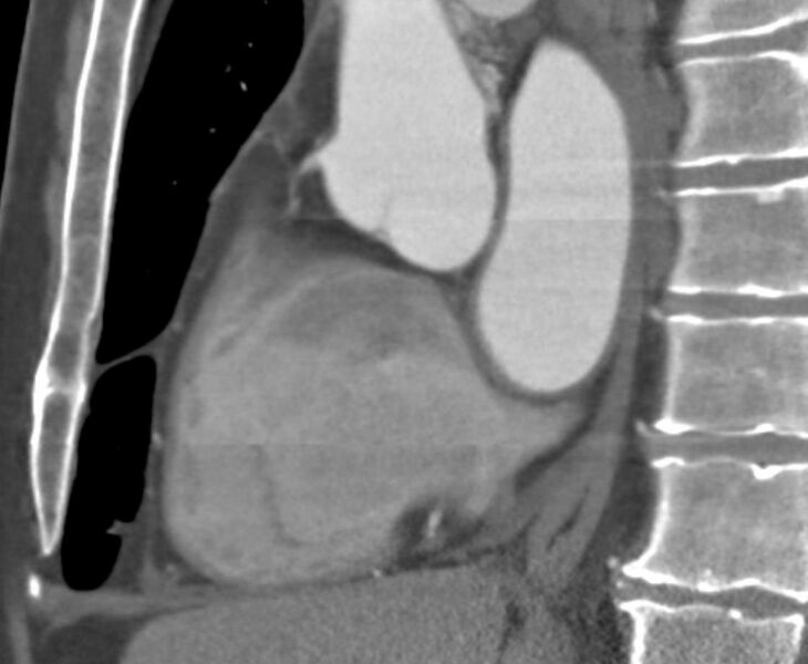 File:Cardiac hemangioma (Radiopaedia 16971-16679 C 14).JPG