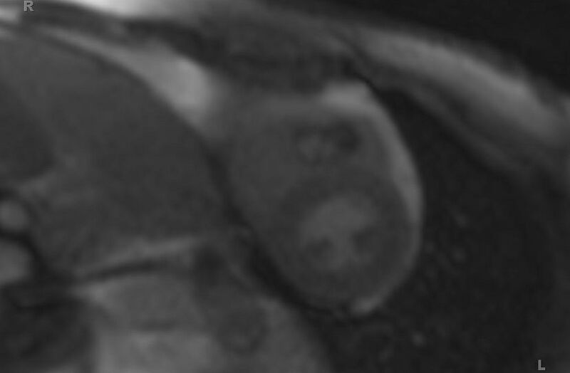 File:Cardiac hemangioma (Radiopaedia 31709-32631 Short axis 62).jpg