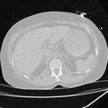 Cardiogenic pulmonary edema (Radiopaedia 29213-29609 Axial lung window 111).jpg
