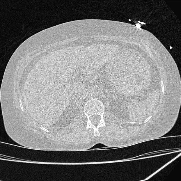 File:Cardiogenic pulmonary edema (Radiopaedia 29213-29609 Axial lung window 111).jpg