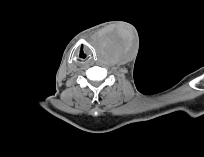 Carotid artery pseudoaneurysm (Radiopaedia 84030-99259 Axial non-contrast 34).jpg