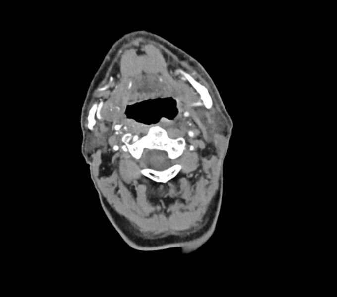 File:Carotid artery pseudoaneurysm (Radiopaedia 84030-99259 C 30).jpg