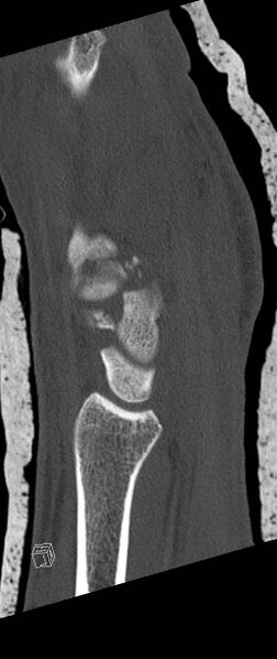 File:Carpal fractures (smart watch impaction) (Radiopaedia 55844-62430 Sagittal bone window 26).jpg