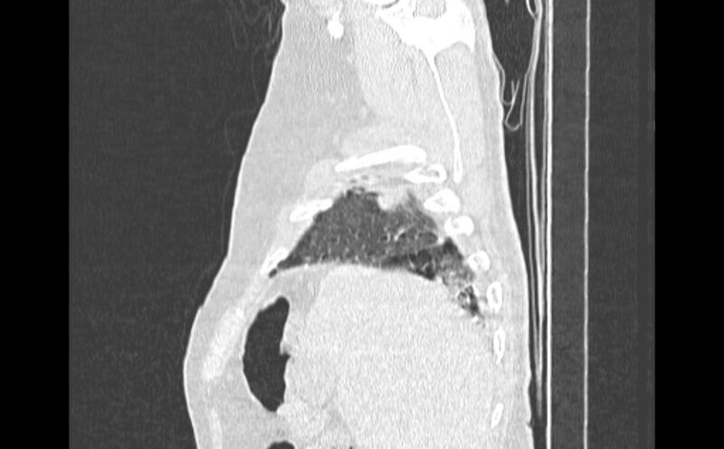 File:Cavitating bronchogenic carcinoma (Radiopaedia 44489-48162 Sagittal lung window 1).jpg