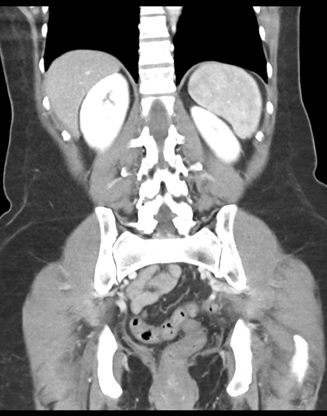 File:Cecum hernia through the foramen of Winslow (Radiopaedia 46634-51112 B 34).png