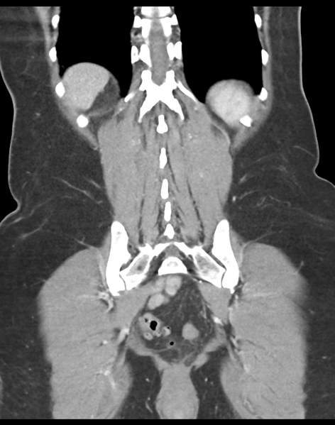 File:Cecum hernia through the foramen of Winslow (Radiopaedia 46634-51112 B 38).png
