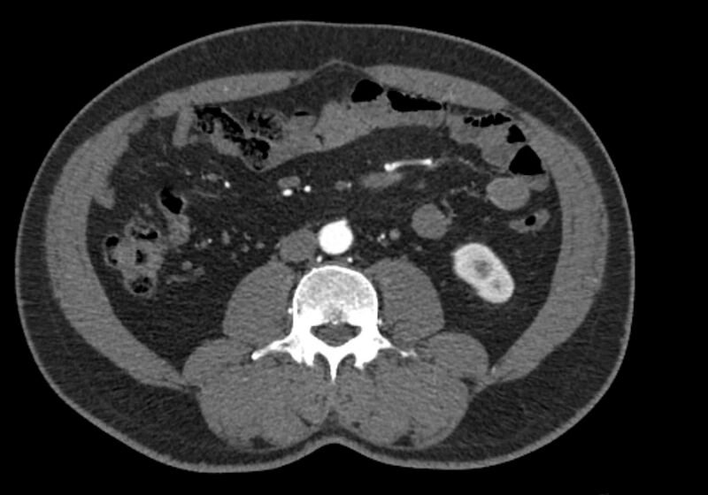 File:Celiac artery dissection (Radiopaedia 52194-58080 A 59).jpg