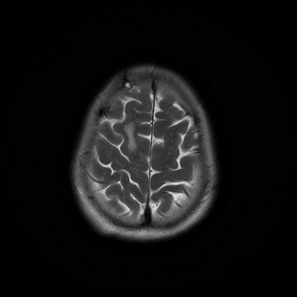 File:Central neurocytoma (Radiopaedia 67618-77021 Axial T2 22).jpg