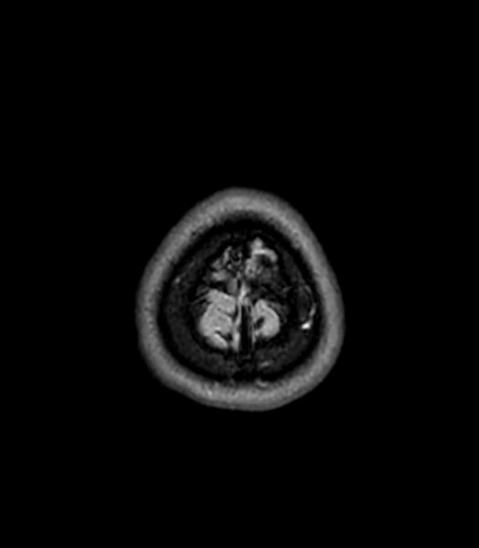 File:Central neurocytoma (Radiopaedia 79320-92380 Axial FLAIR 35).jpg