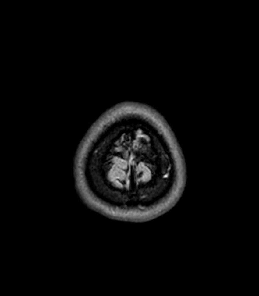Central neurocytoma (Radiopaedia 79320-92380 Axial FLAIR 35).jpg