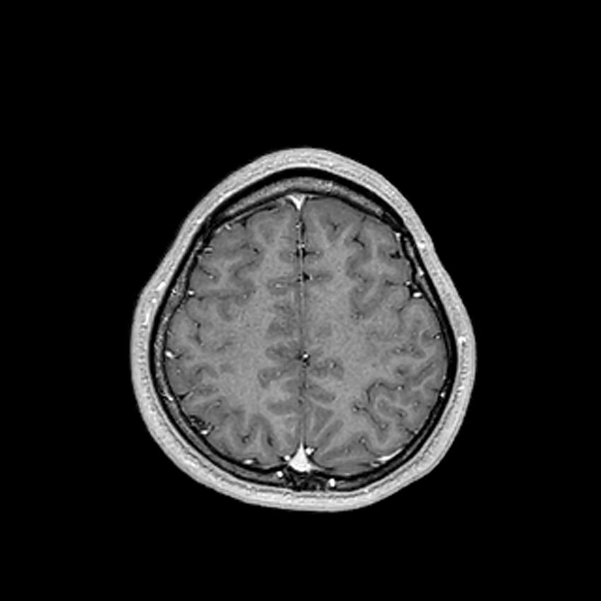 Central neurocytoma (Radiopaedia 79320-92380 Axial T1 C+ 189).jpg