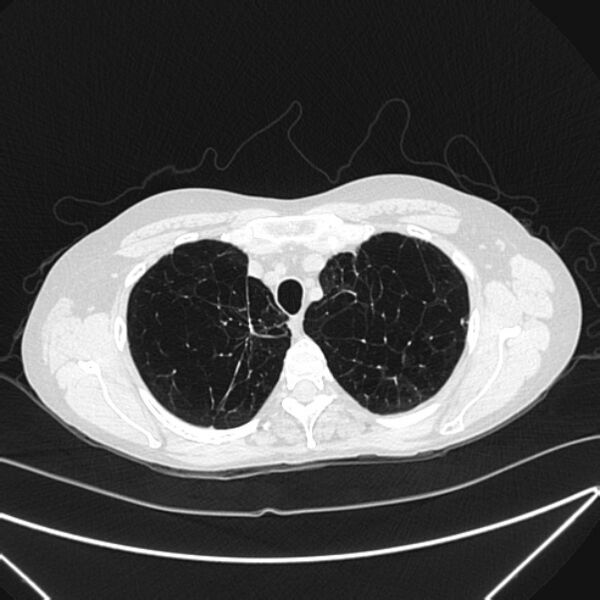 File:Centrilobular pulmonary emphysema (Radiopaedia 24495-24789 Axial lung window 17).jpg