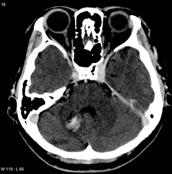 File:Cerebellar arteriovenous malformation (Radiopaedia 5220-36607 A 4).jpg