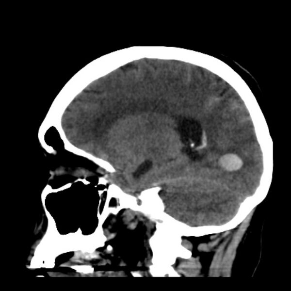 File:Cerebellar hemorrhage causing obstructive hydrocephalus (Radiopaedia 33989-35207 B 31).jpg