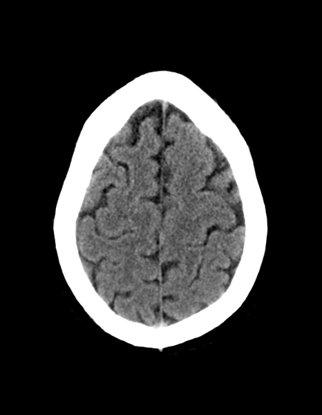 File:Cerebellar infarct due to vertebral artery dissection with posterior fossa decompression (Radiopaedia 82779-97030 Axial non-contrast 28).png