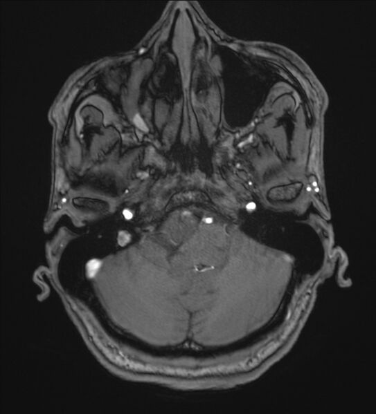 File:Cerebellopontine angle meningioma (Radiopaedia 72983-83680 Axial MRA 17).jpg