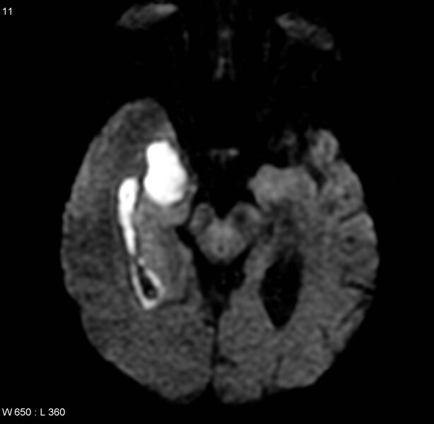 File:Cerebral abscess and ventriculitis (Radiopaedia 5024-6885 Axial DWI 1).jpg