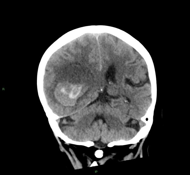 File:Cerebral amyloid angiopathy-associated lobar intracerebral hemorrhage (Radiopaedia 58563-65727 Coronal non-contrast 27).jpg