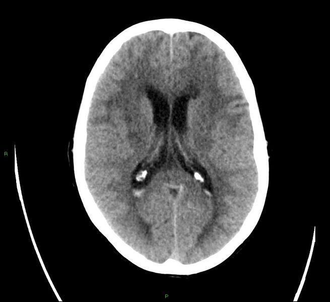 File:Cerebral amyloid angiopathy-associated lobar intracerebral hemorrhage (Radiopaedia 58566-65731 Axial non-contrast 14).jpg