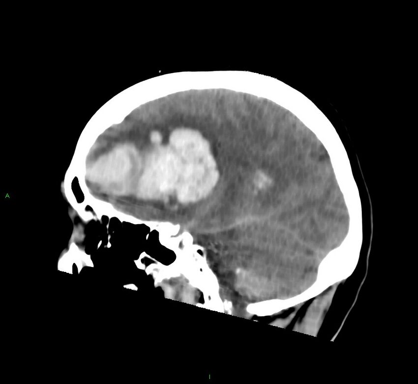 Cerebral amyloid angiopathy-associated lobar intracerebral hemorrhage (Radiopaedia 58752-65973 C 32).jpg