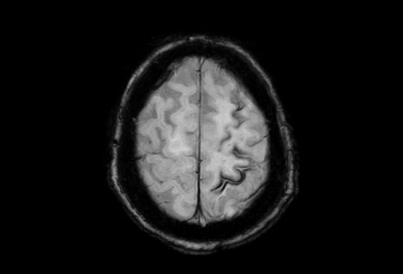 File:Cerebral amyloid angiopathy (Radiopaedia 86671-102792 Axial Gradient Echo 9).jpg