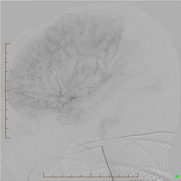 File:Cerebral arteriovenous malformation (AVM) (Radiopaedia 78162-90707 B 15).jpg