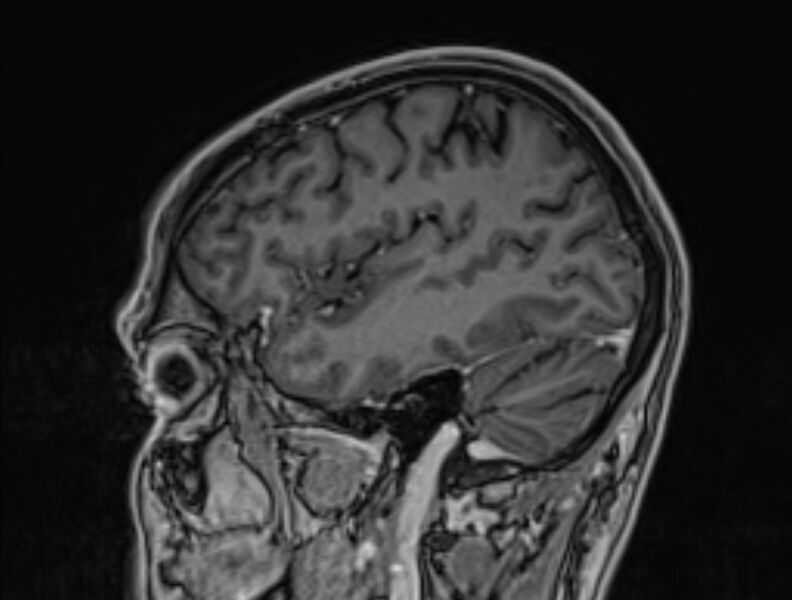 File:Cerebral venous thrombosis (Radiopaedia 71207-81504 Sagittal T1 C+ 12).jpg