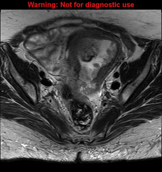 File:Cervical cancer (Radiopaedia 24151-24410 Axial T2 12).jpg