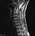 Cervical disc extrusion (Radiopaedia 5216-6982 Sagittal T2 2).jpg