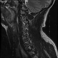 Cervical flexion teardrop fracture with cord hemorrhage (Radiopaedia 32497-33455 Sagittal T2 3).jpg
