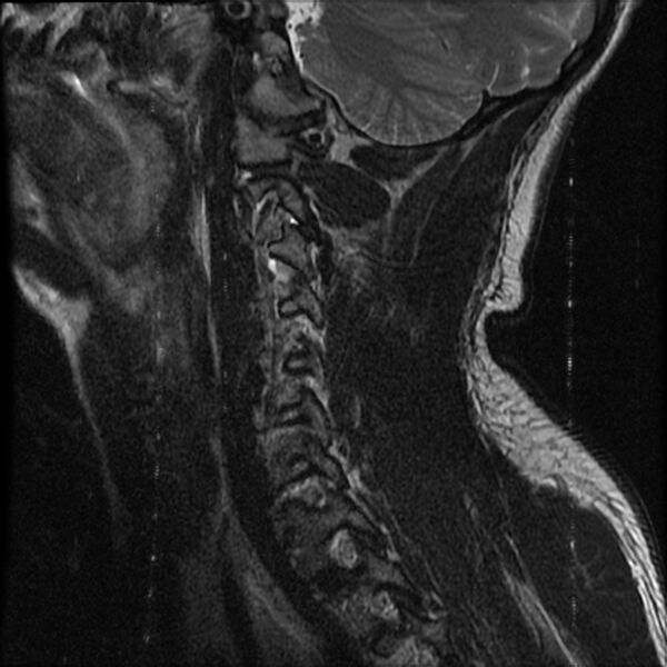 File:Cervical flexion teardrop fracture with cord hemorrhage (Radiopaedia 32497-33455 Sagittal T2 3).jpg