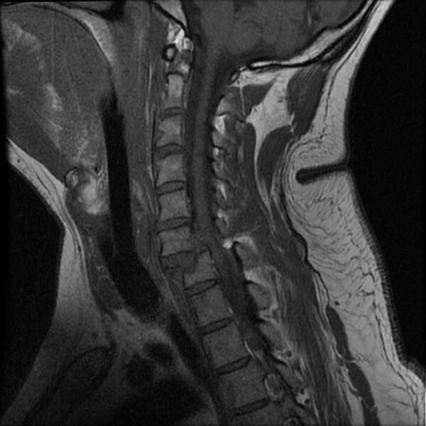 File:Cervical fracture and dislocation with locked facet (Radiopaedia 31837-32781 Sagittal T1 6).jpg