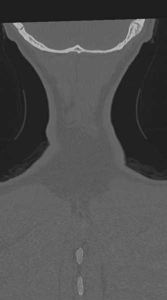 File:Cervical intercalary bone (Radiopaedia 35211-36748 Coronal bone window 78).png