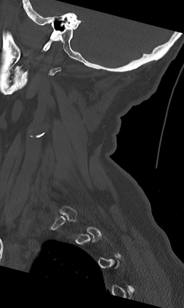 File:Cervical spine fracture - chalk stick (Radiopaedia 39116-41323 Sagittal bone window 12).png