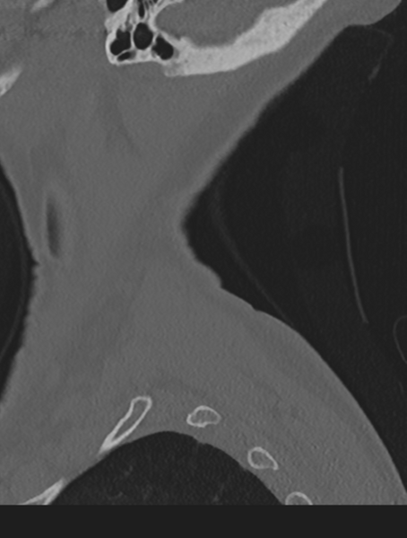 File:Cervical spondylolysis (Radiopaedia 49616-54811 Sagittal bone window 70).png