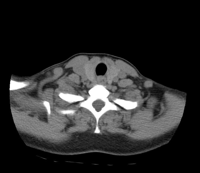 File:Cervical venous malformation (Radiopaedia 22653-22672 Axial non-contrast 44).jpg