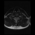 Cervical vertebrae metastasis (Radiopaedia 78814-91667 Axial T2 4).png
