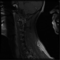 Cervical vertebrae metastasis (Radiopaedia 78814-91667 G 4).png
