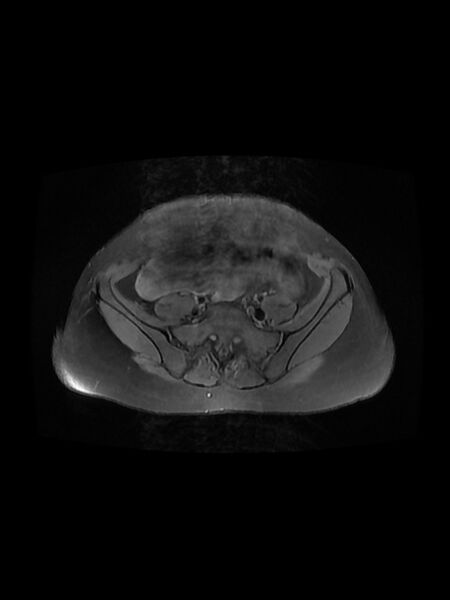 File:Cesarean section scar endometrioma (Radiopaedia 56569-63297 Axial PD fat sat 9).jpg
