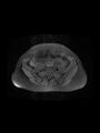 Cesarean section scar endometrioma (Radiopaedia 56569-63297 Axial PD fat sat 9).jpg