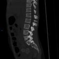 Chance fracture with duodenal and pancreatic lacerations (Radiopaedia 43477-50042 Sagittal bone window 8).jpg