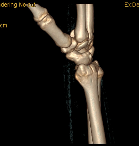 File:Chauffeur's (Hutchinson) fracture (Radiopaedia 58043-65079 3D volume rendered images 4).png