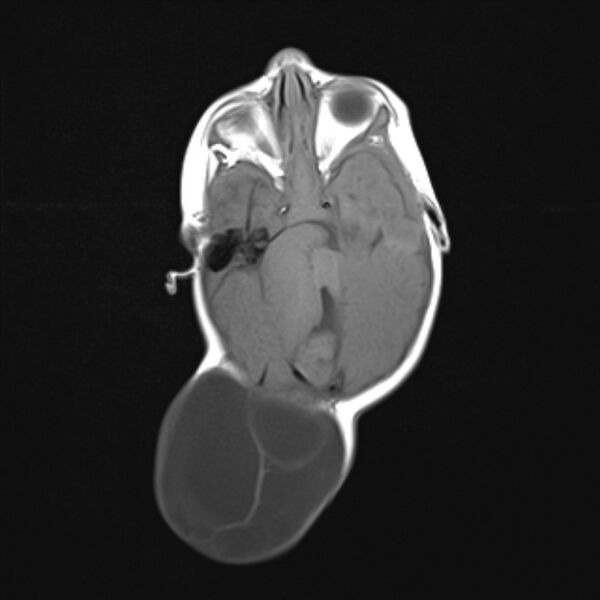 File:Chiari III malformation with occipital encephalocele (Radiopaedia 79446-92559 Axial T1 12).jpg