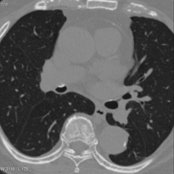 File:Chicken bone in bronchus (Radiopaedia 6550-7861 Axial lung window 2).jpg