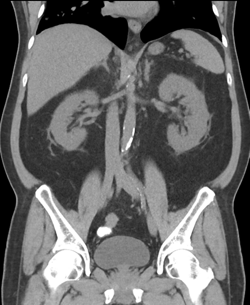 File:Cholecystitis with focal perforation and hepatic abscess (Radiopaedia 37189-38945 Coronal non-contrast 34).png