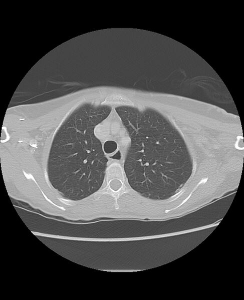 File:Chondrosarcoma (Radiopaedia 79427-92532 Axial lung window 15).jpg