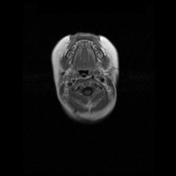 File:Choroid plexus carcinoma (Radiopaedia 21121-21035 Axial T1 C+ 1).jpg