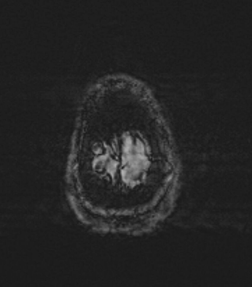 Choroid plexus carcinoma (Radiopaedia 91013-108553 Axial SWI 92).jpg