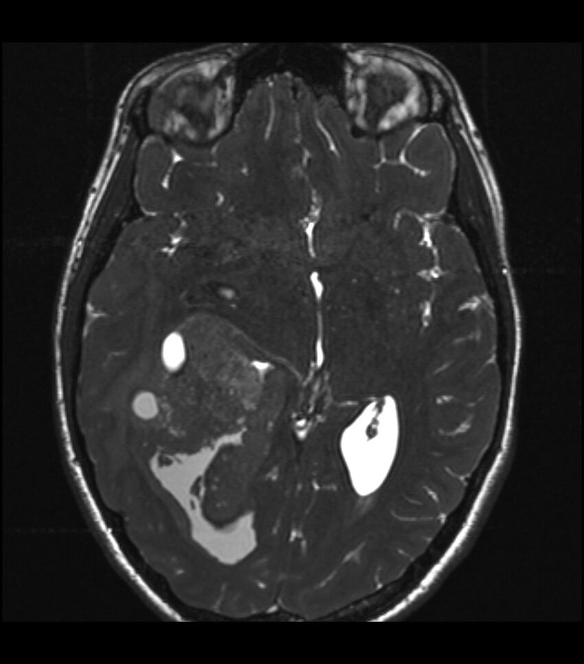 Choroid plexus carcinoma (Radiopaedia 91013-108553 Axial T2 CISS 34).jpg
